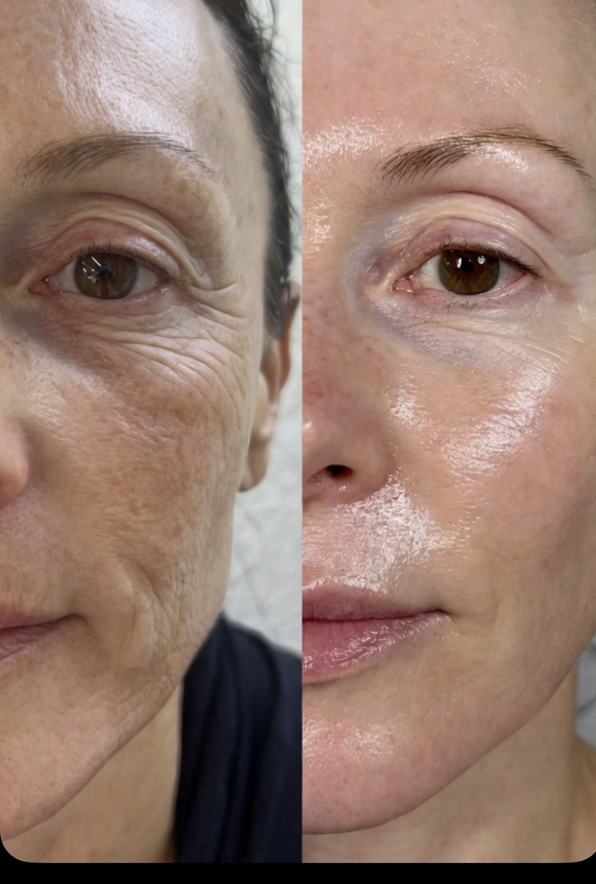 Anti-Aging Facial treatment result