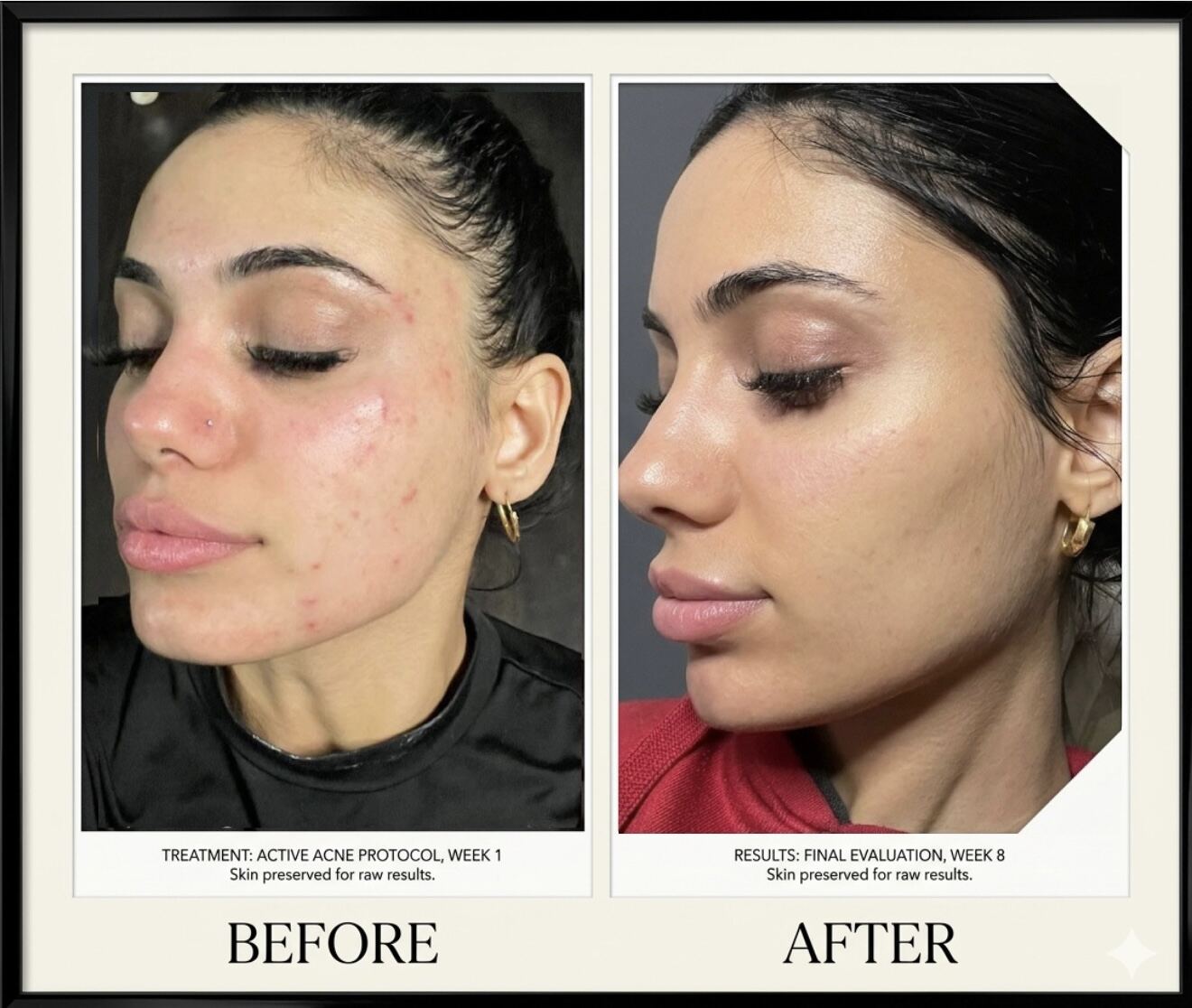 Chemical Peel treatment result