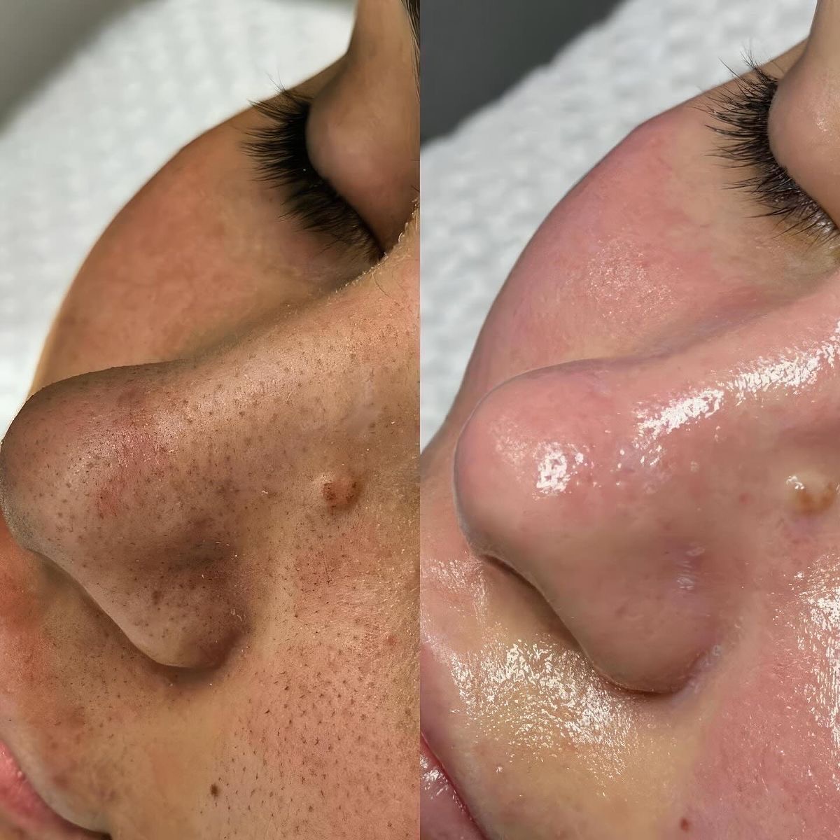 Deep Pore Cleansing Facial treatment result
